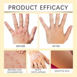 Vitigo Bee Venom Treatment Cream | Natural Skin Repair Hydration Relief Anti-Irritation